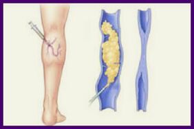 Die Sklerotherapie ist eine beliebte Methode zur Beseitigung von Krampfadern an den Beinen